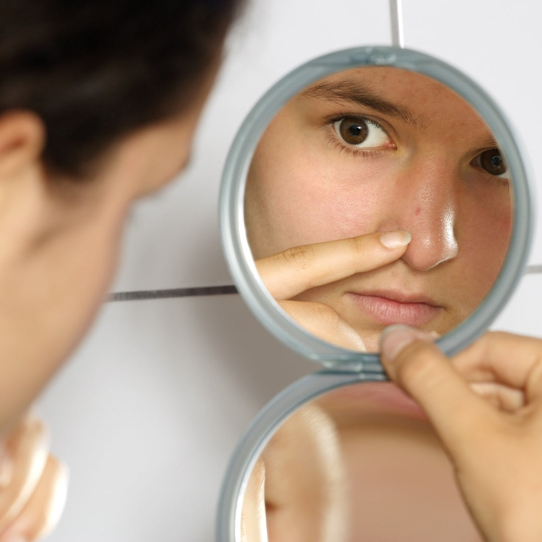 The Truth About Teen Acne: Myths, Facts, and Natural Solutions